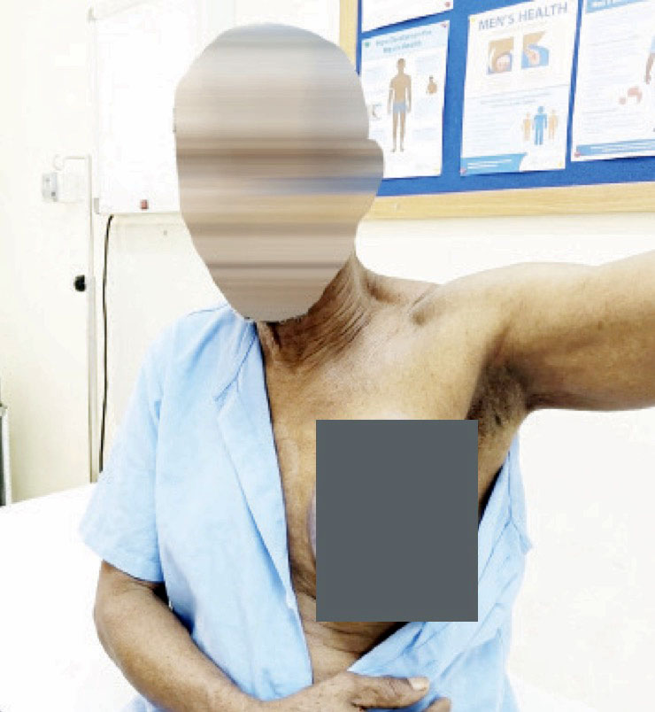 •A breast cancer patient -Please blur face and chest.