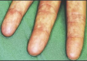 Adermatoglyphia fingers