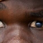blindness