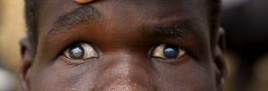 blindness