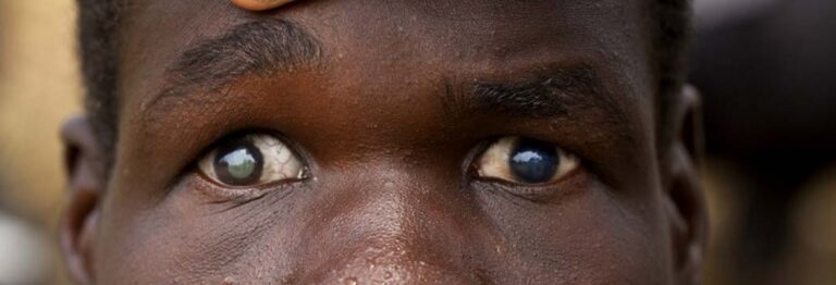 eyes blindness