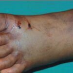 Snake-bite-1