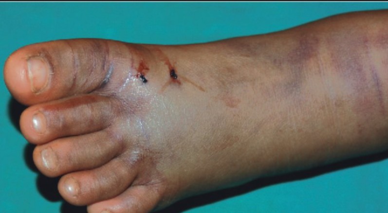 Snake-bite-1